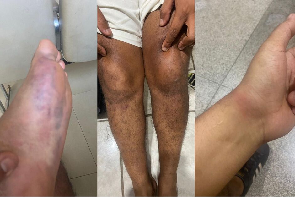 Marcas de hematomas ficaram pelo corpo da vítima