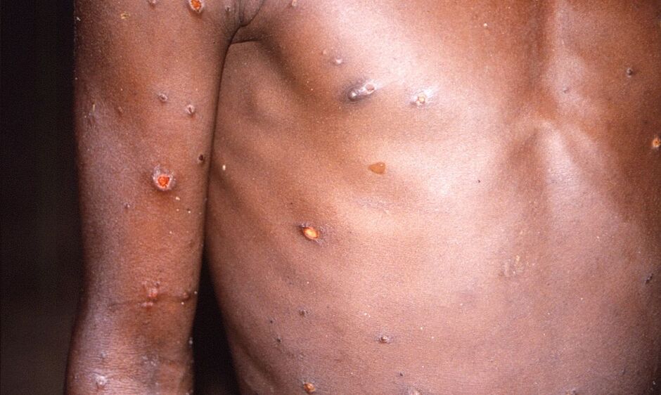 Dez casos de Varíola dos macacos foram confirmados em MS