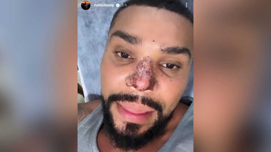 Naldo foi às redes sociais para falar sobre complicação