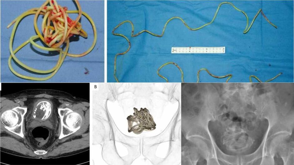 Foi necessário fazer cirurgia por causa da forma como a corda ficou enrolada 