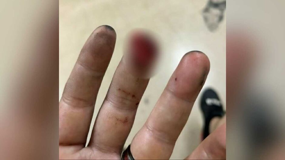 De ruim: motociclista perdeu o controle da moto e, em seguida, a ponta do dedo médio 