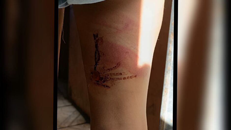 Ferimentos e marcas de sangue em uma das pernas da adolescente