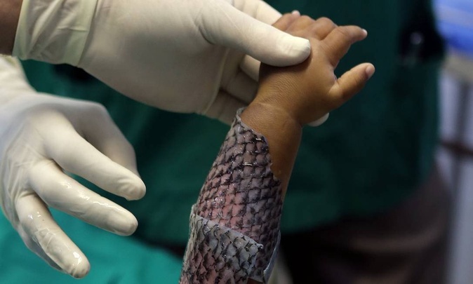 Tratamento com pele de tilápia oferece mais vantagens, quando comparado com os tradicionais