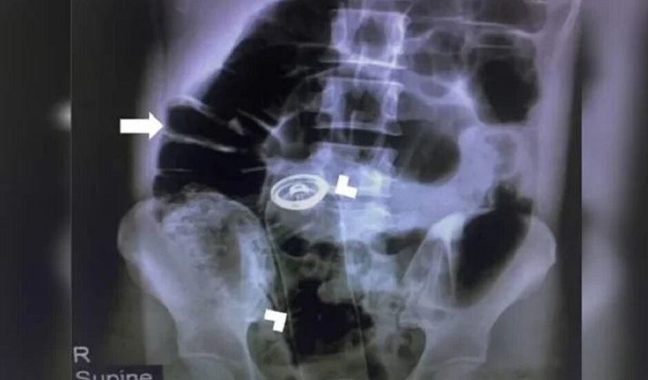 Esta não foi a primeira vez que o homem teve ocorrência de introdução de objetos no corpo