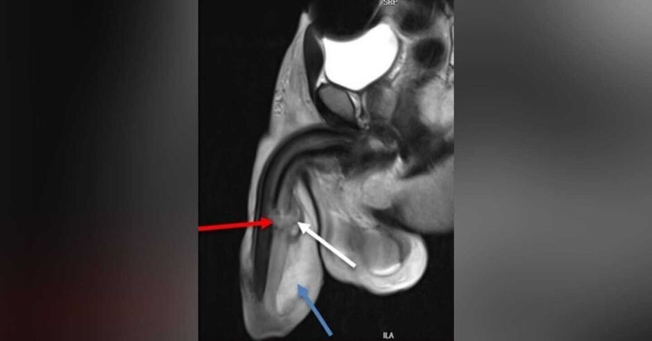 Paciente foi diagnosticado com uma "fratura peniana tripla