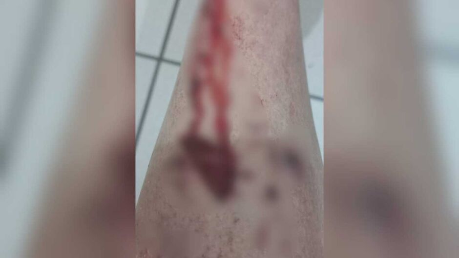 Perna da vítima ficou com um buraco