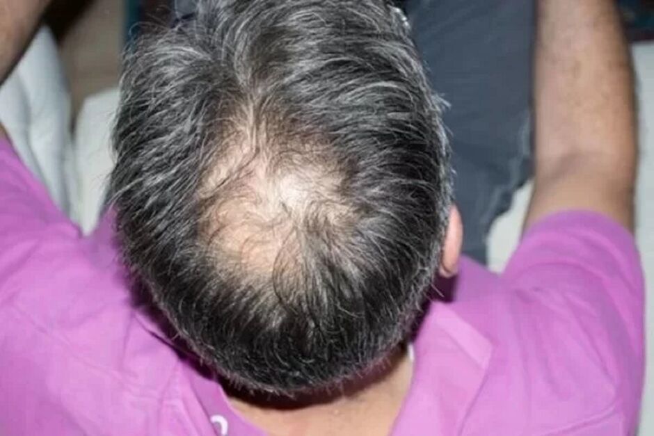 Cl&iacute;nica procura volunt&aacute;rios para pesquisa sobre calv&iacute;cie 