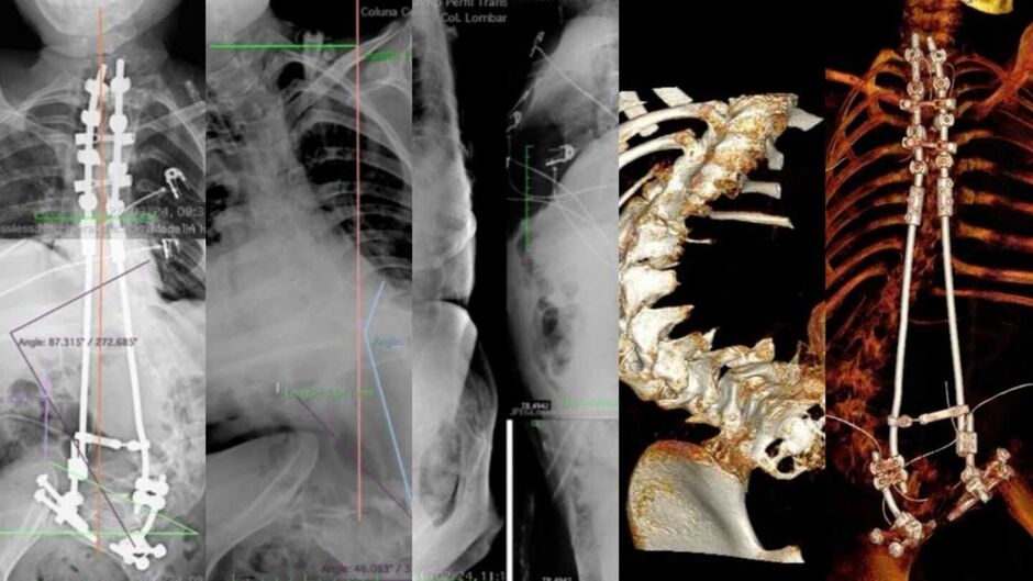 Imagem de coro era a coluna da paciente antes da cirurgia