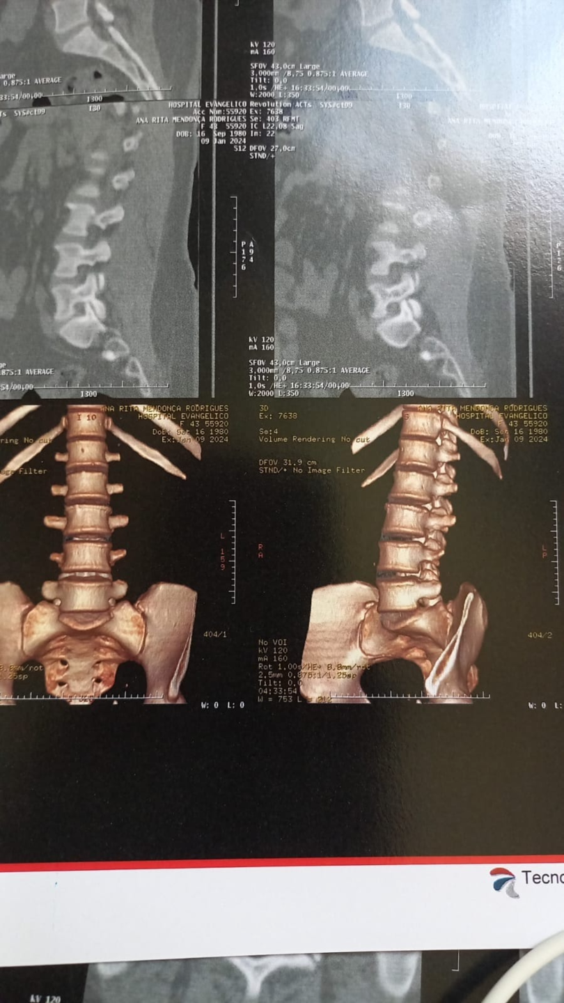 Além da Espondilite, ela contraiu dengue hemorrágica e foi diagnosticada com hepatite medicamentosa