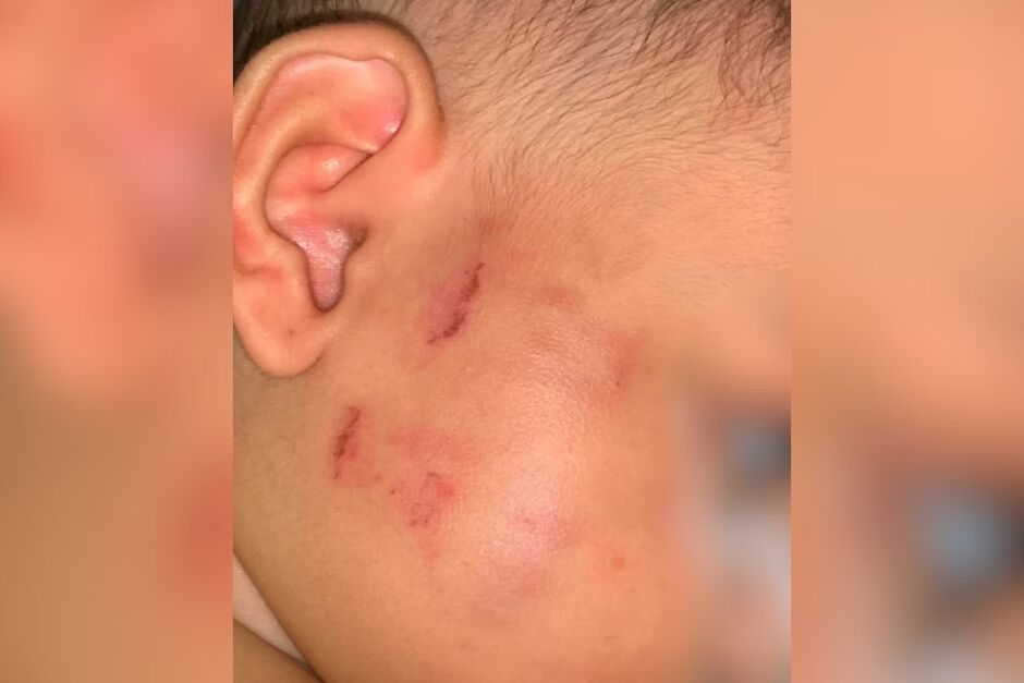 Mordidas ficaram visíveis na bebê