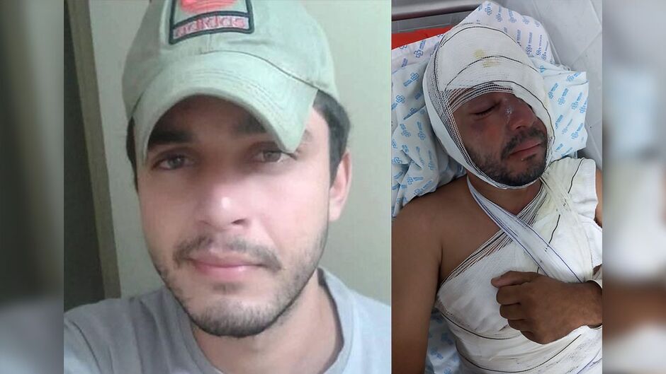 Homem atacado com água fervente recebe alta e fará tratamento para recuperar visão 