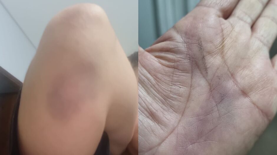 Marcas da última agressão sofrida pela vítima