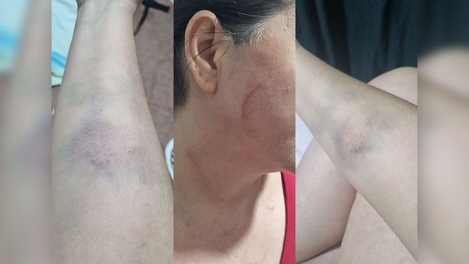 Ana Claudia com marcas de agressões cometidas em novembro de 2024 por parte do ex-companheiro