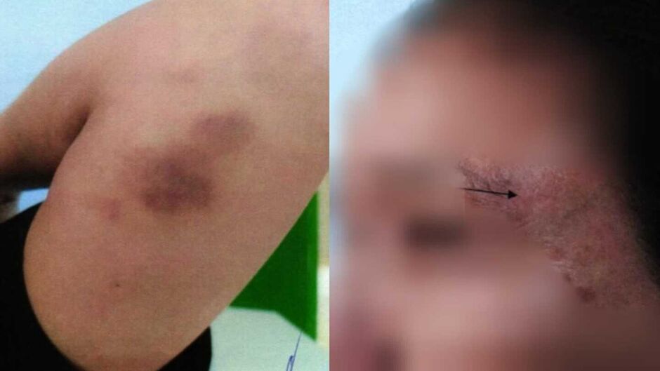 Vítima tinha marcas no rosto e nos braços de agressões cometidas pelo companheiro