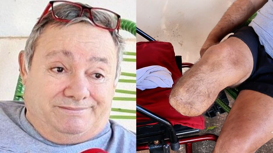 Carlinhos precisa da prótese para vida normal novamente