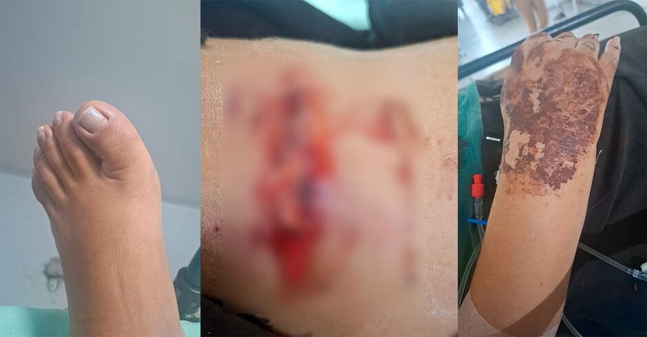 Vítima fraturou os dois braços e o dedo do pé
