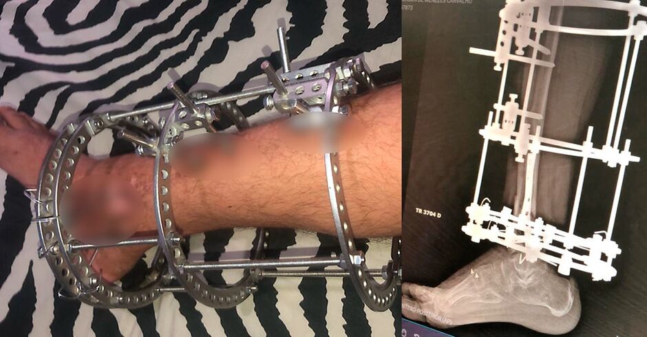 Perna de Emerson de Menezes Carvalho