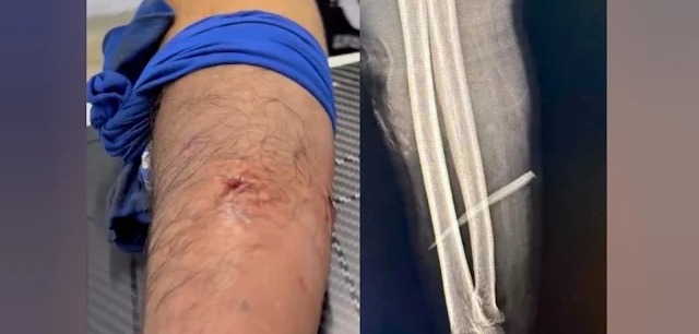 Ele foi ferroado na quarta-feira, durante uma pescaria