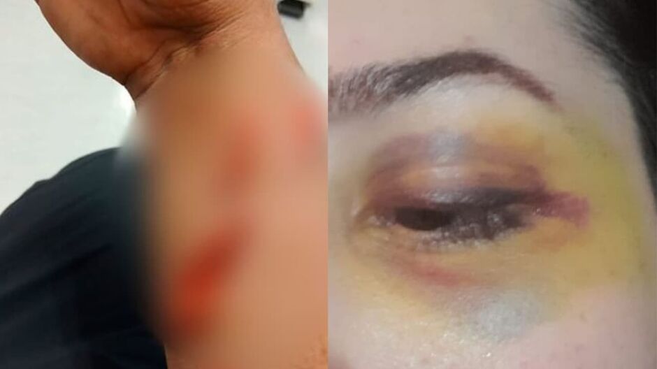 Braço do marido cortado com garrada e o olho da esposa roxo