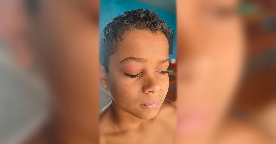 Hytalo Valtevir Souza Silva, de 11 anos, luta pela vida após ser diagnosticado com um tumor no olho
