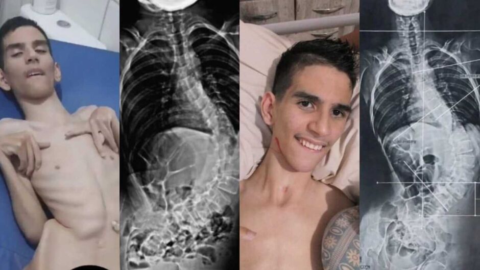 7 anos depois, jovem consegue cirurgia de escoliose e precisa de doa&ccedil;&atilde;o de sangue em Campo Grande