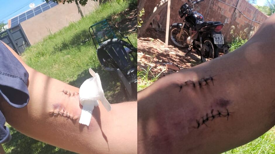 Baleado no bra&ccedil;o, homem contesta vers&atilde;o oficial e diz que foi cobrar d&iacute;vida antes de ser atacado