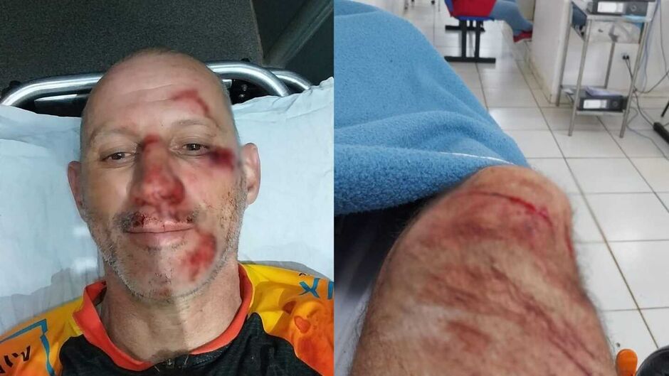 A v&iacute;tima sofreu diversas escoria&ccedil;&otilde;es graves pelo corpo 