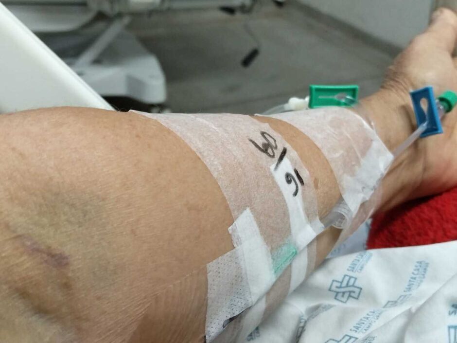 Diab&eacute;tica operou perna quebrada, mas contraiu uma bact&eacute;ria