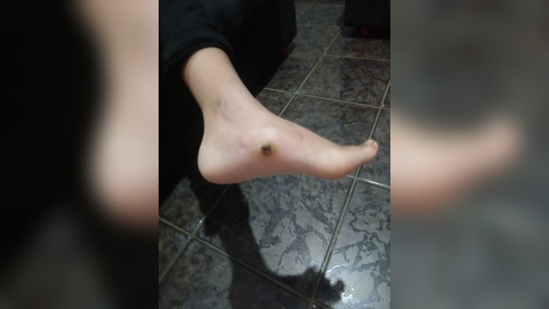 Machucado no pé do menino preocupa o pai, Milton. Foto: Arquivo pessoal