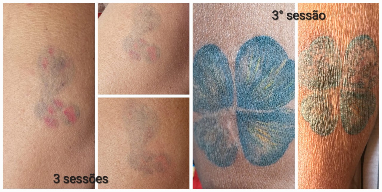 Remoção com jato de plasma exige mais sessões, mas também tem bons resultados